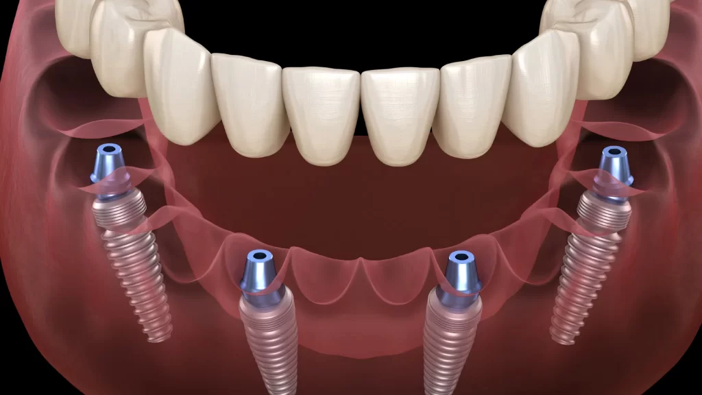 All-on-4 dental implants on jaw model