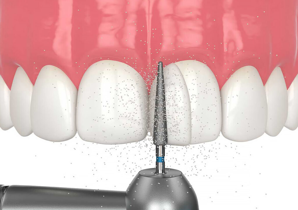 Dental bonding procedure on tooth close-up