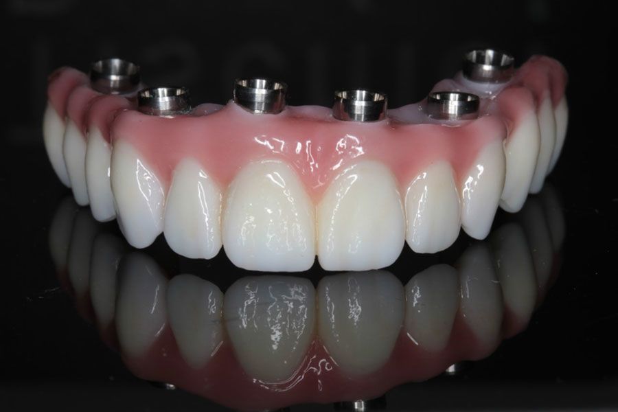 Full mouth reconstruction dental treatment
